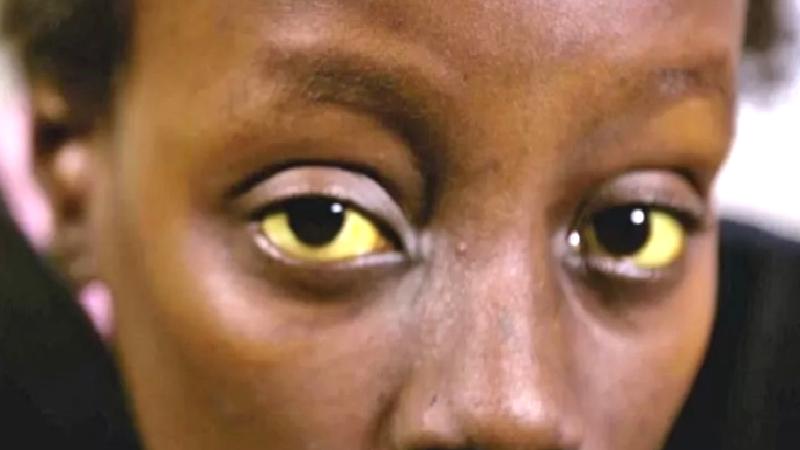 Orak hücre anemisi: Afrika’da çok zor mücadele edilen genetik hastalık