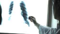 Doç. Dr. Yakup Arslan: Akciğer kanseri adı konmamış bir pandemi