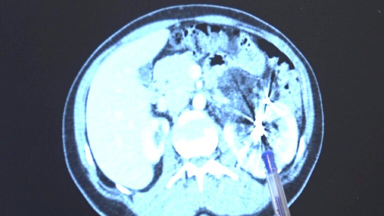 Fıtık için gittiği hastanede tek böbrekli olduğunu öğrendi