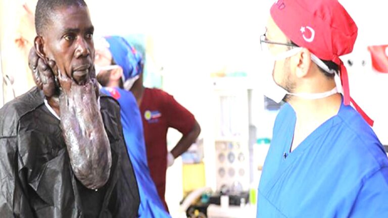 Ugandalı Muhammed’i, yüzündeki 5 kiloluk kitleden Türk doktorlar kurtardı