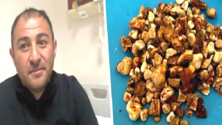 Böbreklerinden 300’ü aşkın taş çıktı: “Hatırası var” deyip evine götürdü