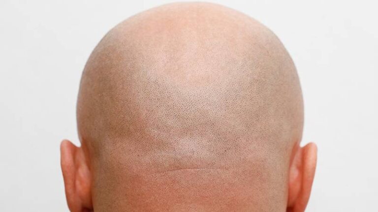 Klinik deneyler olumlu: 30 yılın ardından kellik tedavisinde ilk yeni etki mekanizması!