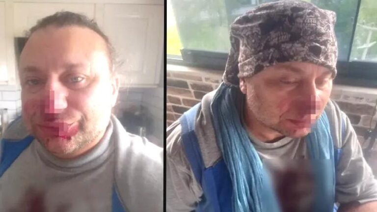 Köpek saldırısının ardından “et yiyen bakteri” şüphesi: Onur Akay entübe edildi