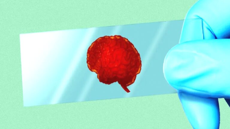 Türkiye’de Alzheimer için umut veren gelişme: Tanıda kan testi, tedavide yeni ilaçlar